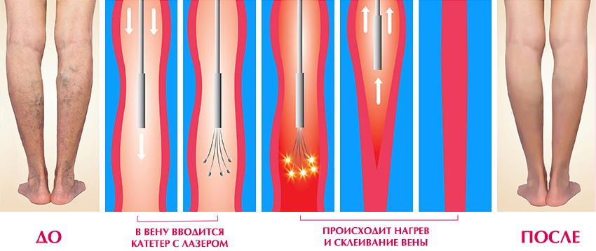 Эндовазальная (эндовенозная) лазерная коагуляция