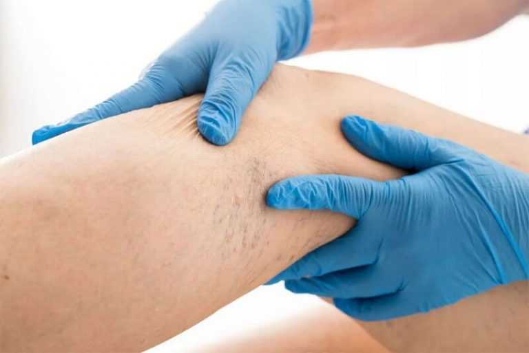 Диагностика ретикулярного варикоза