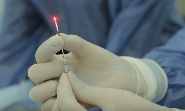 Современное лечение геморроя: лазер, лигирование или склеротерапия? Разбираемся, что выбрать