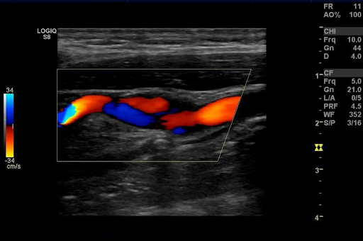 Сканирование артерий