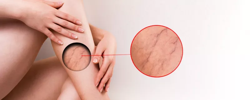 Ретикулярный варикоз