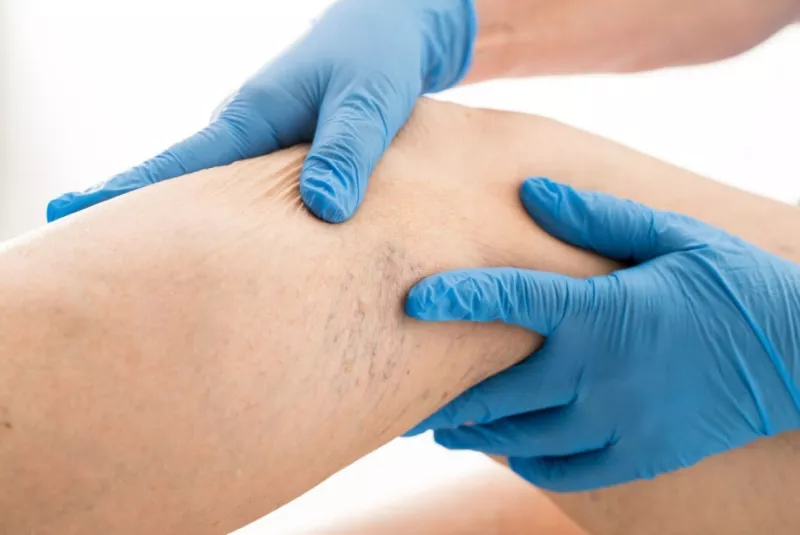 Профилактика варикоза