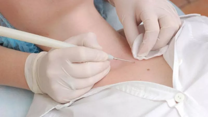 Что лучше: лазерное или радиоволновое удаление родинок, папиллом, бородавок 