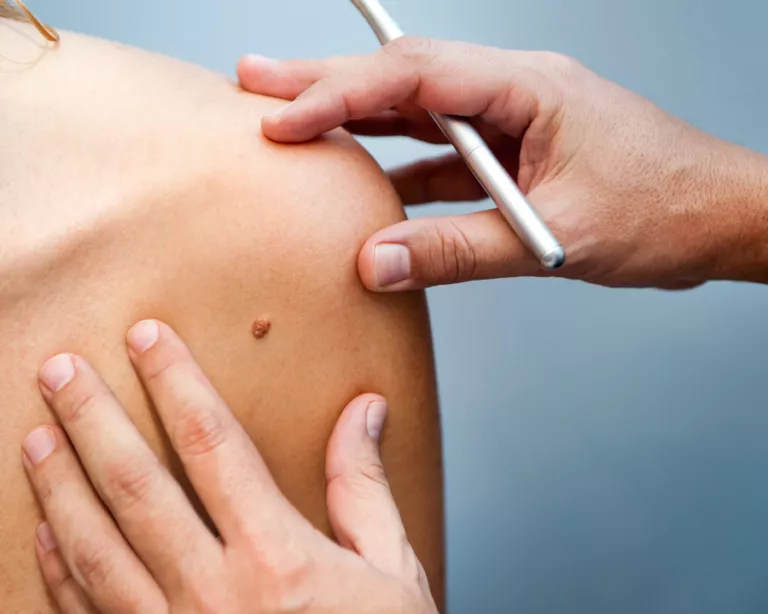 Хирургия одного дня: как избавиться от гигромы, папиллом и бородавок быстро и без следа